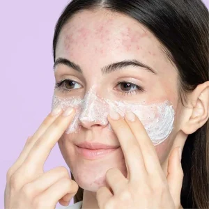 Lumeraskin | Dùng sữa rửa mặt bao lâu hết mụn? Bí quyết từ chuyên gia da liễu